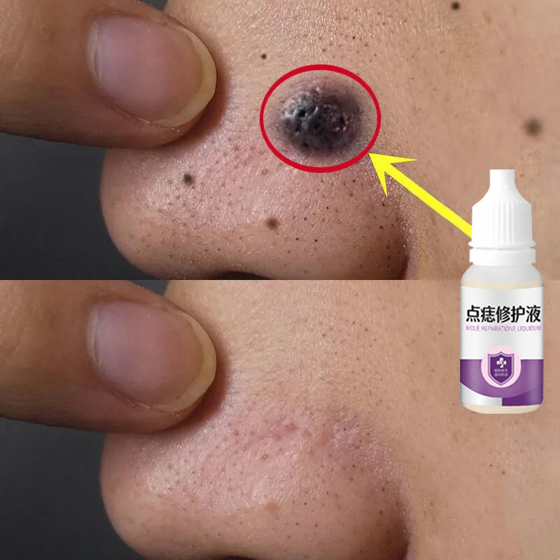 Gel Tẩy Nốt Ruồi Kem tẩy nốt ruồi serum tẩy nốt ruồi 10ml 7 ngày nhanh chóng xóa mụn ruồi trên mặt, mụn cóc, mụn thịt , mụn cơm,Mụn ruồi đen Mụn ruồi lồi