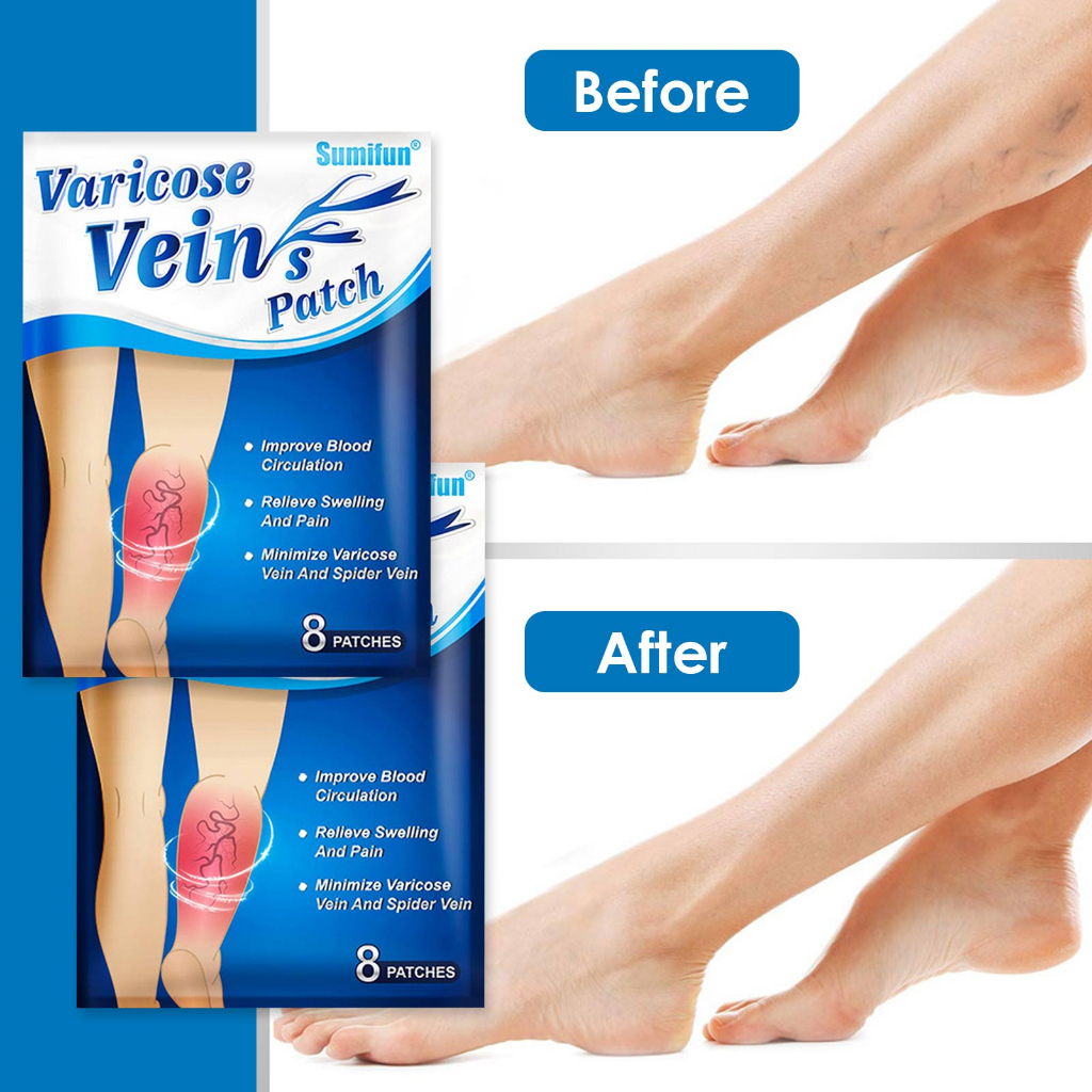 Miếng Dán Trị Giãn Tĩnh Mạch Trung Hoa Hiệu Quả