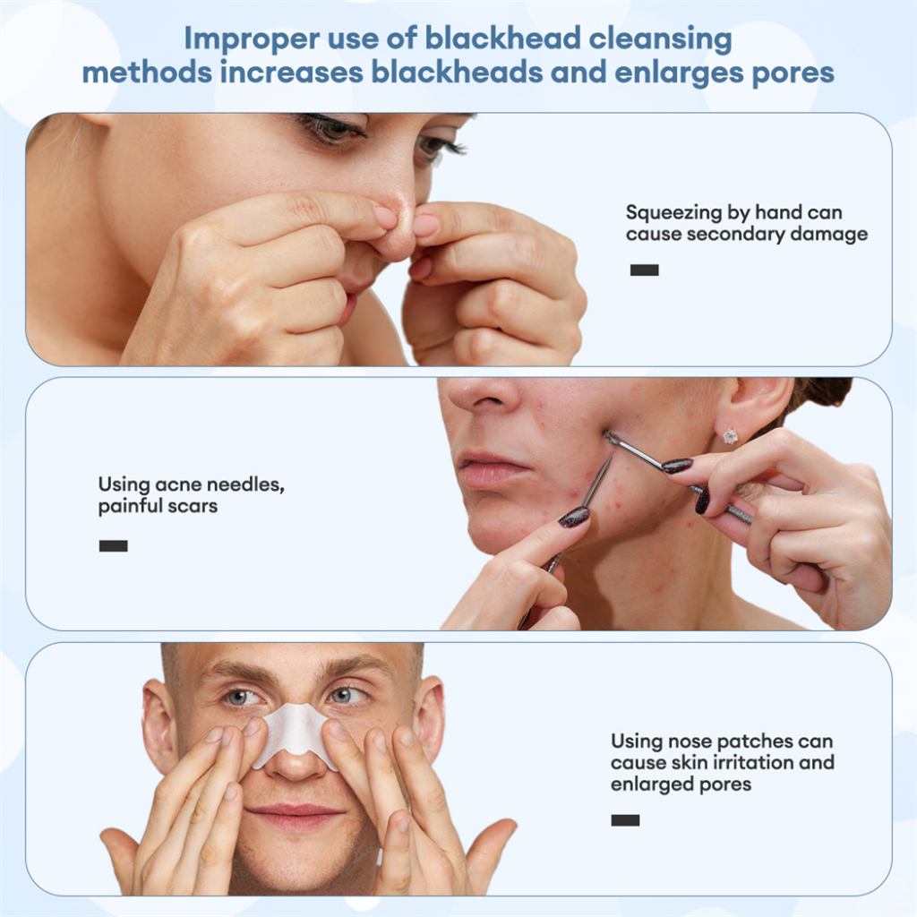 Ckeyin Máy Hút Mụn Đầu Đen Làm Sạch Sâu Lỗ Chân Lông