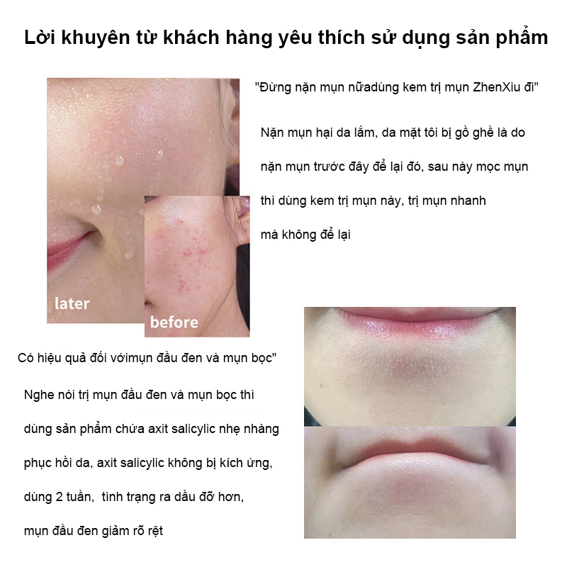 Kem chấm mụn Gel giảm mụn, giảm thâm ngăn mụn tái phát, kem bôi mụn làm mờ thâm mụn