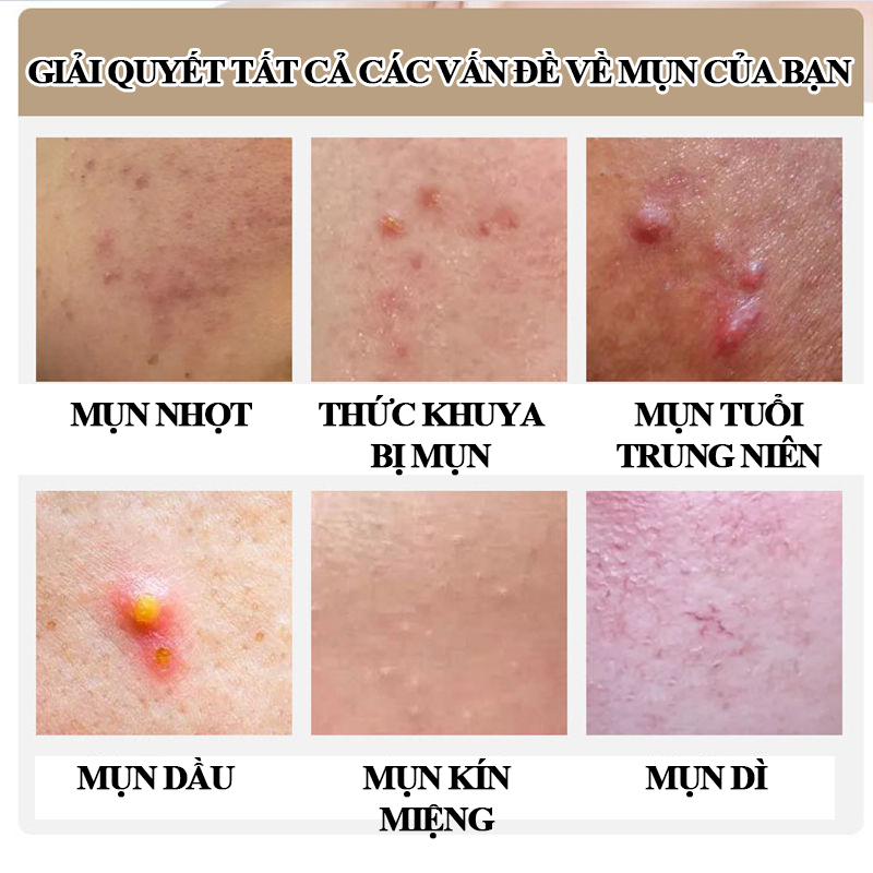 Kem chấm mụn Gel giảm mụn, giảm thâm ngăn mụn tái phát, kem bôi mụn làm mờ thâm mụn