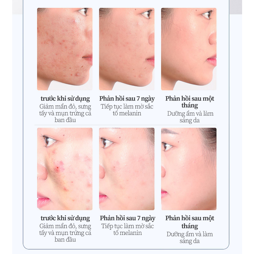 Kem chấm mụn Gel giảm mụn, giảm thâm ngăn mụn tái phát, kem bôi mụn làm mờ thâm mụn