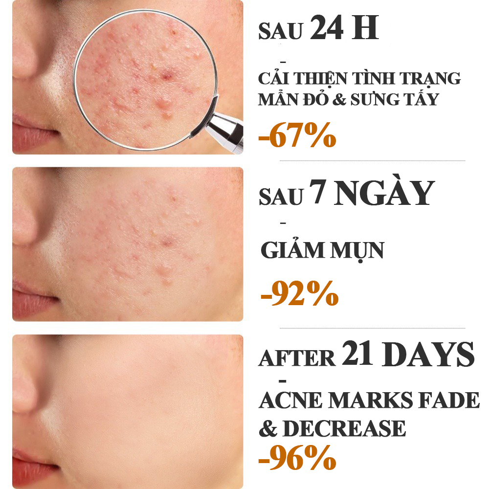 Kem chấm mụn Gel giảm mụn, giảm thâm ngăn mụn tái phát, kem bôi mụn làm mờ thâm mụn