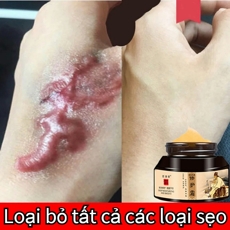 ⭐CHÍNH HÃNG⭐ Kem phục hồi sẹo Kem làm mờ vết sẹo kem chăm sóc sẹo 50g Khổi phục da bỏng và bỏng nước vết thương phẫu thuật sẹo thâm