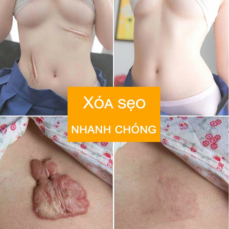 ⭐CHÍNH HÃNG⭐ Kem phục hồi sẹo Kem làm mờ vết sẹo kem chăm sóc sẹo 50g Khổi phục da bỏng và bỏng nước vết thương phẫu thuật sẹo thâm