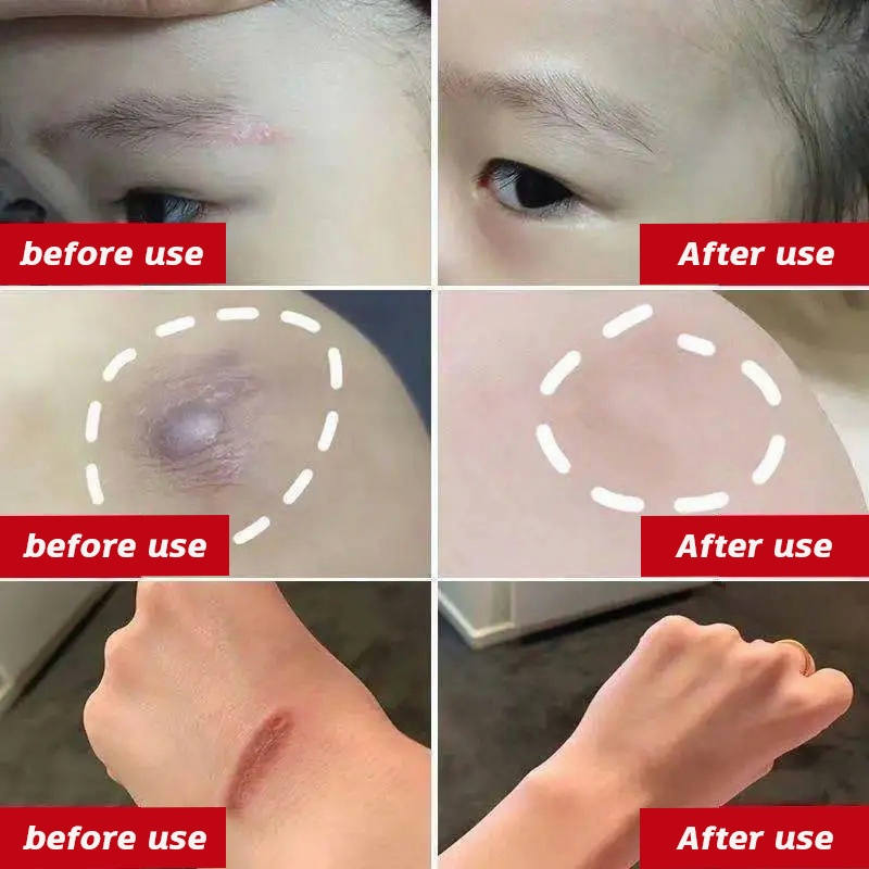 ⭐CHÍNH HÃNG⭐ Kem phục hồi sẹo Kem làm mờ vết sẹo kem chăm sóc sẹo 50g Khổi phục da bỏng và bỏng nước vết thương phẫu thuật sẹo thâm