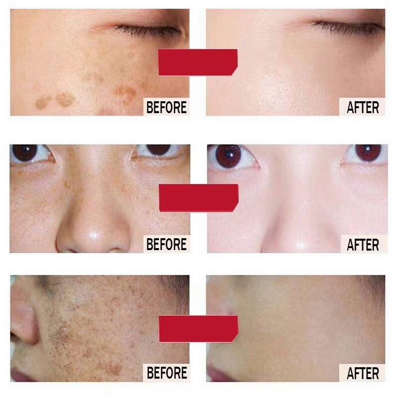 ⭐CHÍNH HÃNG⭐ kem nám tàn nhang Serum nám tàn nhang100ml Loại bỏ tàn nhang và làm trắng nhanh dưỡng ẩm làm sáng Chống lão hóa