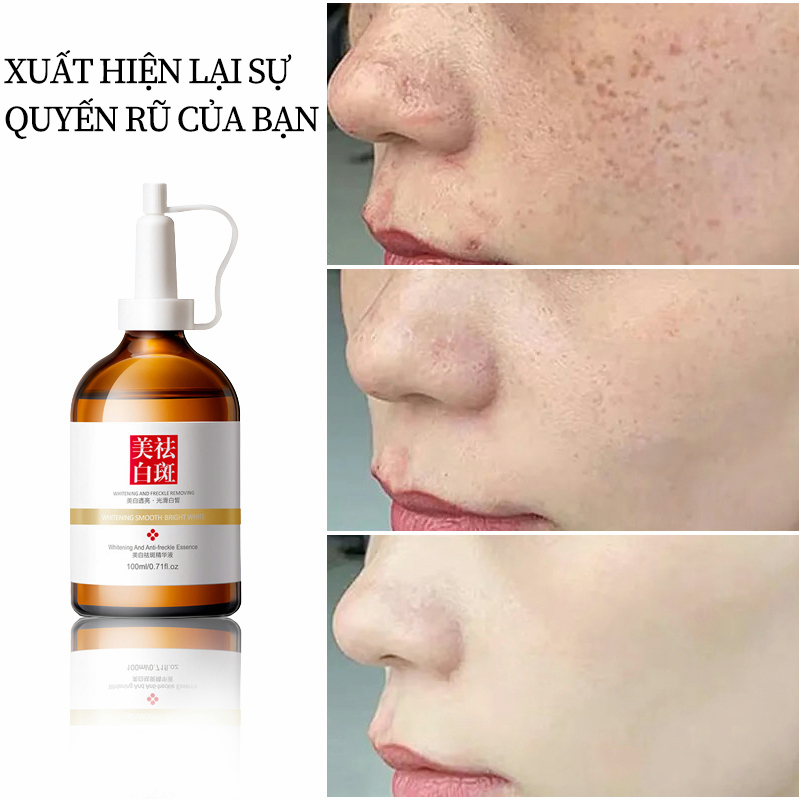 ⭐CHÍNH HÃNG⭐ kem nám tàn nhang Serum nám tàn nhang100ml Loại bỏ tàn nhang và làm trắng nhanh dưỡng ẩm làm sáng Chống lão hóa