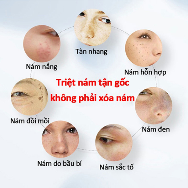 ⭐CHÍNH HÃNG⭐ kem nám tàn nhang Serum nám tàn nhang100ml Loại bỏ tàn nhang và làm trắng nhanh dưỡng ẩm làm sáng Chống lão hóa