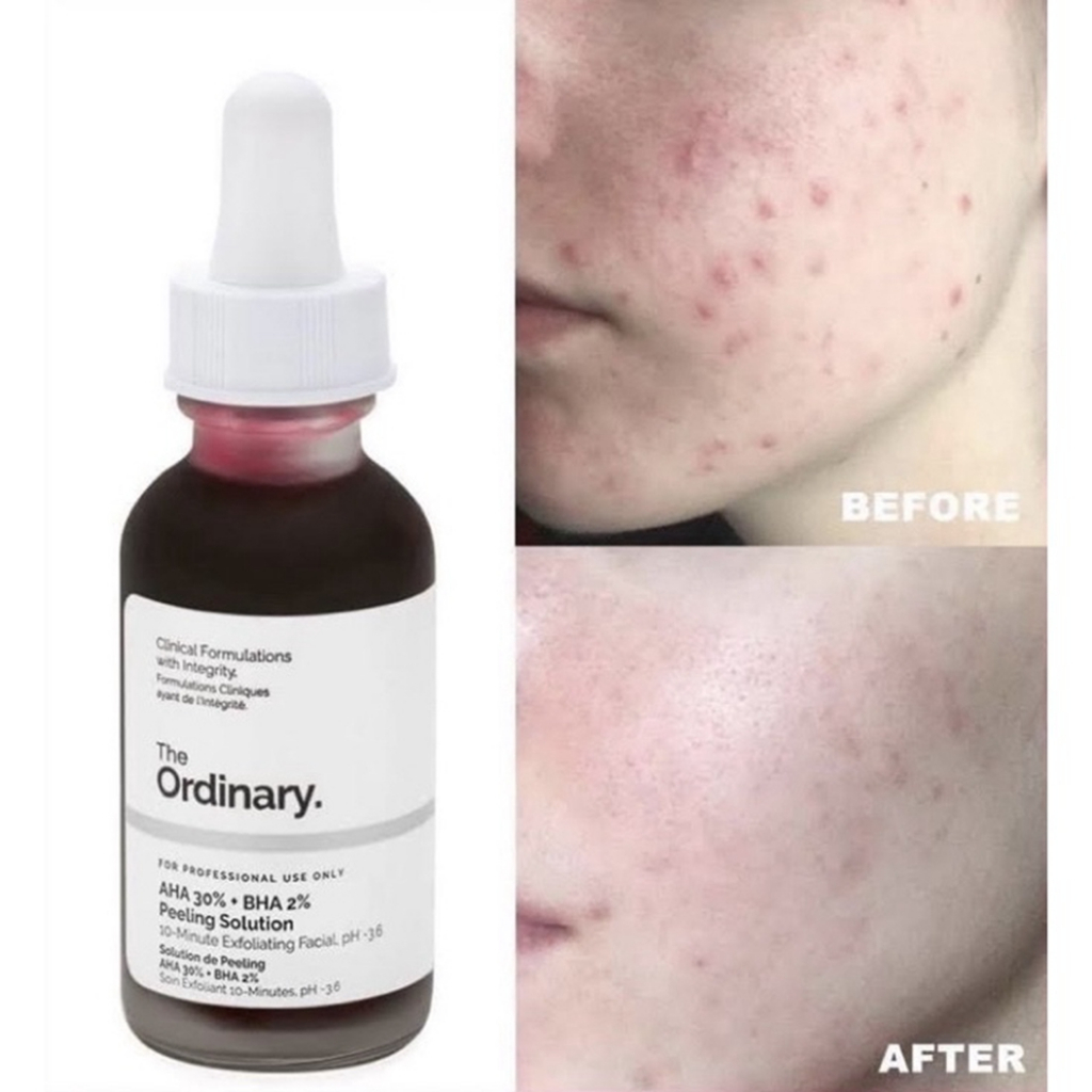 The Ordinary AHA 30%+BHA 2%  30ml Tinh chất Peel da Peeling Solution 30ml dành cho mọi loại da giúp loại bỏ thế bào chết