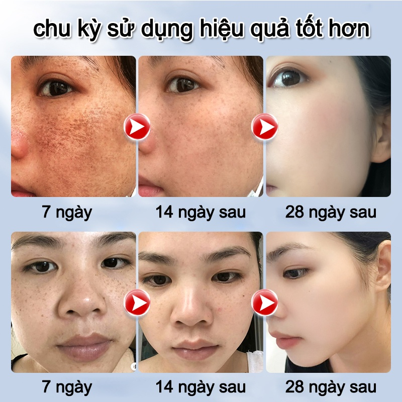 kem trắng da mặt 50ml kem nám tàn nhang Kem trắng da và xóa tàn nhang Hiệu quả làm mờ thâm nám tàn nhan