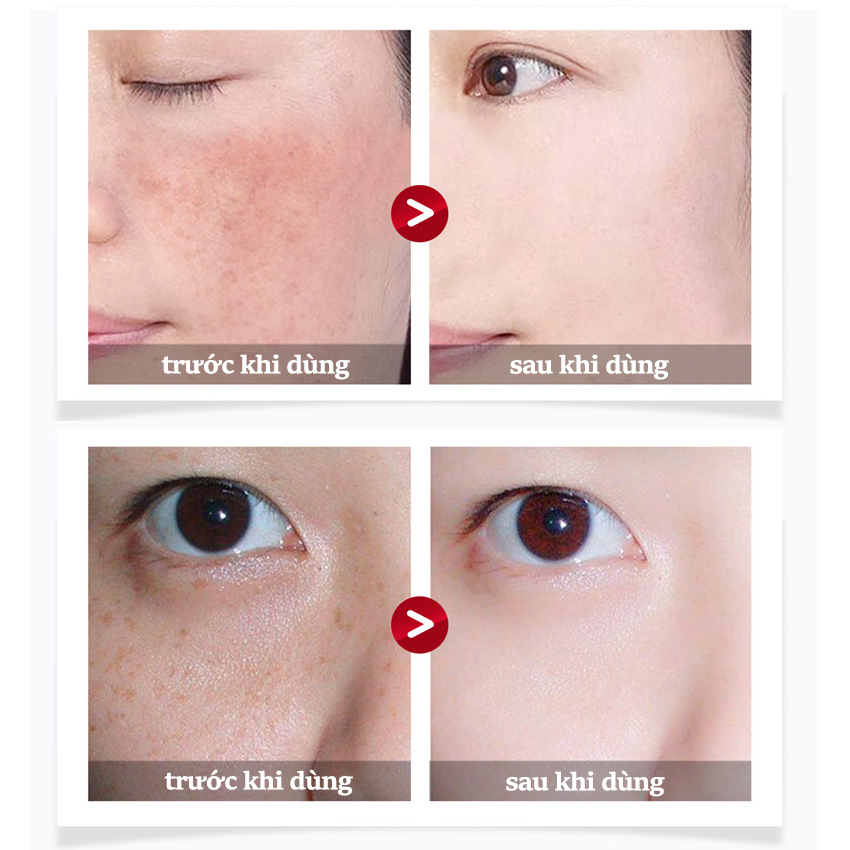 ⭐CHÍNH HÃNG⭐Tinh chất làm trắng sạch tàn nhang 20g*3 Kem trắng da và xóa tàn nhang, Hiệu quả làm mờ thâm nám tàn nhan, Kem nám tàn nhang