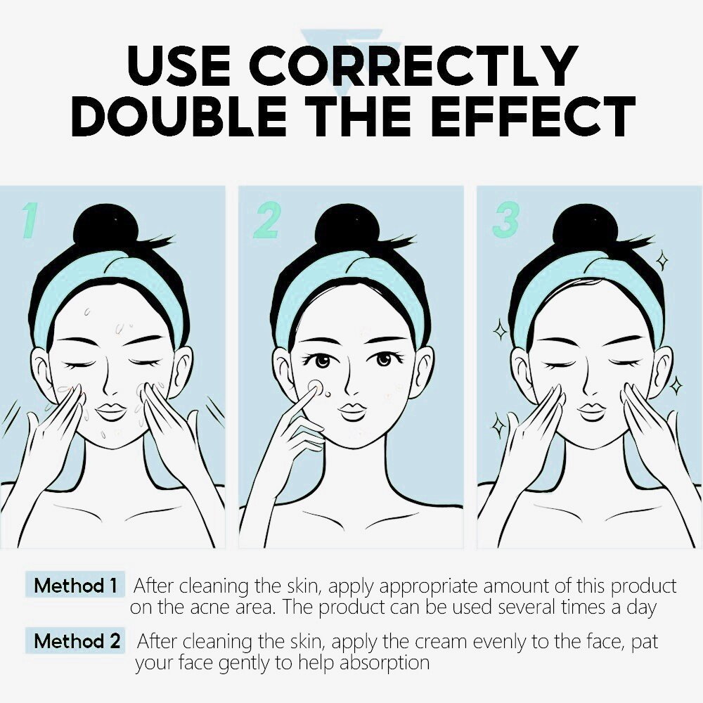 Giselan làm sạch cơ bắp Pox làm đẹp kem, giữ ẩm, làm sáng da mụn trứng cá kem, kem mặt 20g Kem Giảm Mụn Mủ Mụn Bọc Mụn Viêm An Toàn Cho Mọi Loại Da Acnevir Santafa Xanh 20G