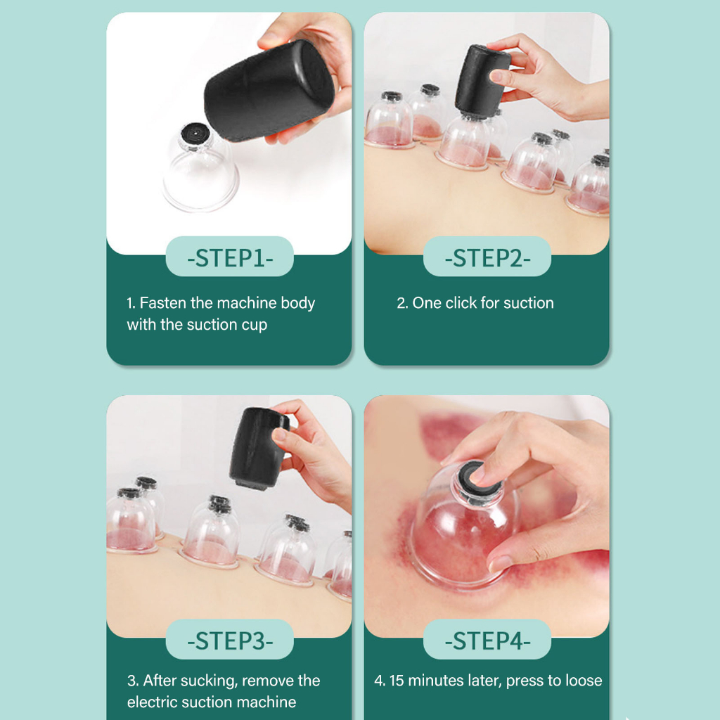 Máy giác hơi chân không thông minh 6 cốc Làm nóng cơ thể Nạo vét máy mát xa SUNCOL