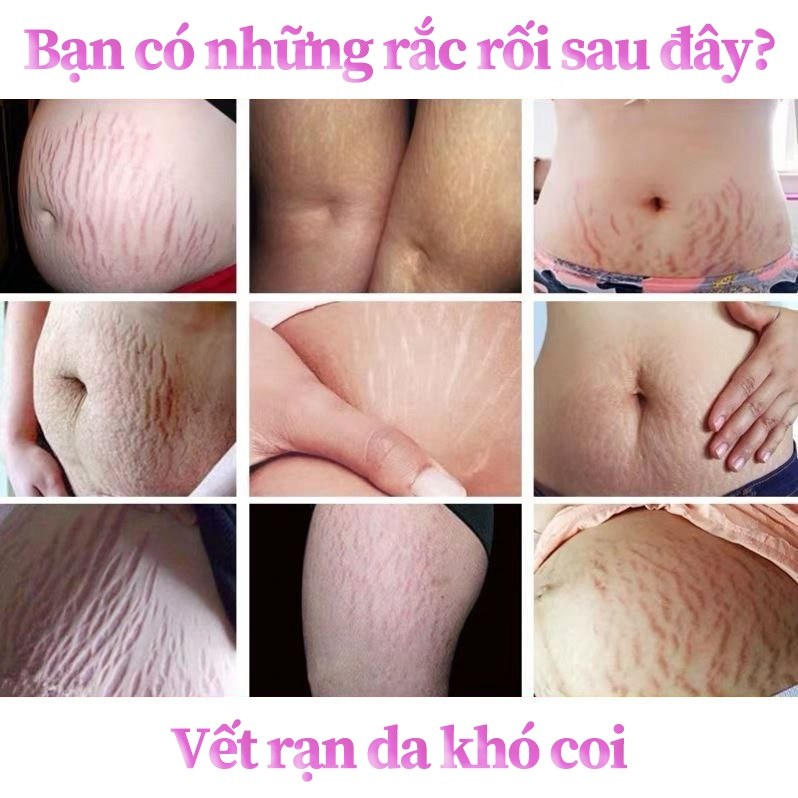 Kem rạn da Kem xoá rạn da sau sinh làm mờ vết thâm tăng độ đàn hồi cho da làm trắng
