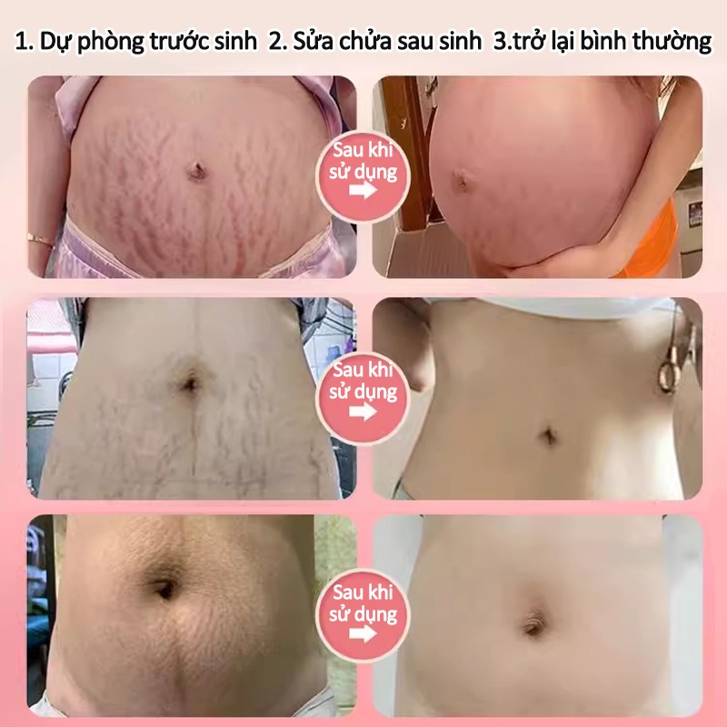Kem rạn da Kem xoá rạn da sau sinh làm mờ vết thâm tăng độ đàn hồi cho da làm trắng