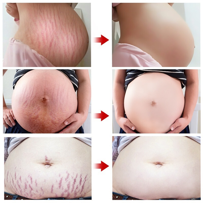 Kem rạn da Kem xoá rạn da sau sinh làm mờ vết thâm tăng độ đàn hồi cho da làm trắng