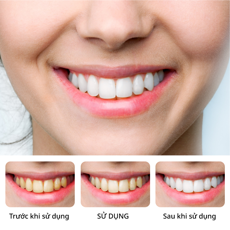 Kem đánh răng làm trắng Canban chứa probiotic hỗ trợ chăm sóc răng 120g