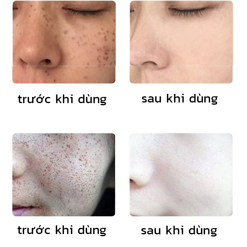 ⭐CHÍNH HÃNG⭐ Tinh chất làm trắng sạch tàn nhang 30ml Kem trắng da và xóa tàn nhang, Hiệu quả làm mờ thâm nám tàn nha