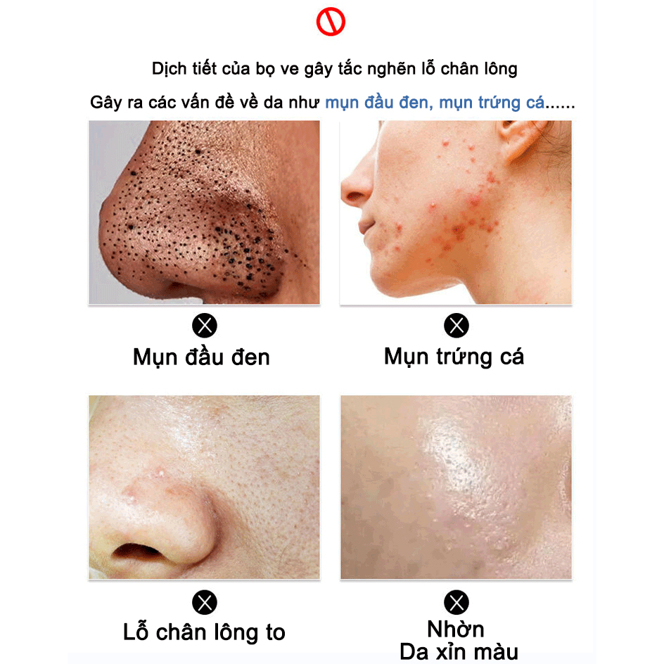 Sữa rửa mặt FUSHITING Azelaic Acid 100g thích hợp cho da mụn