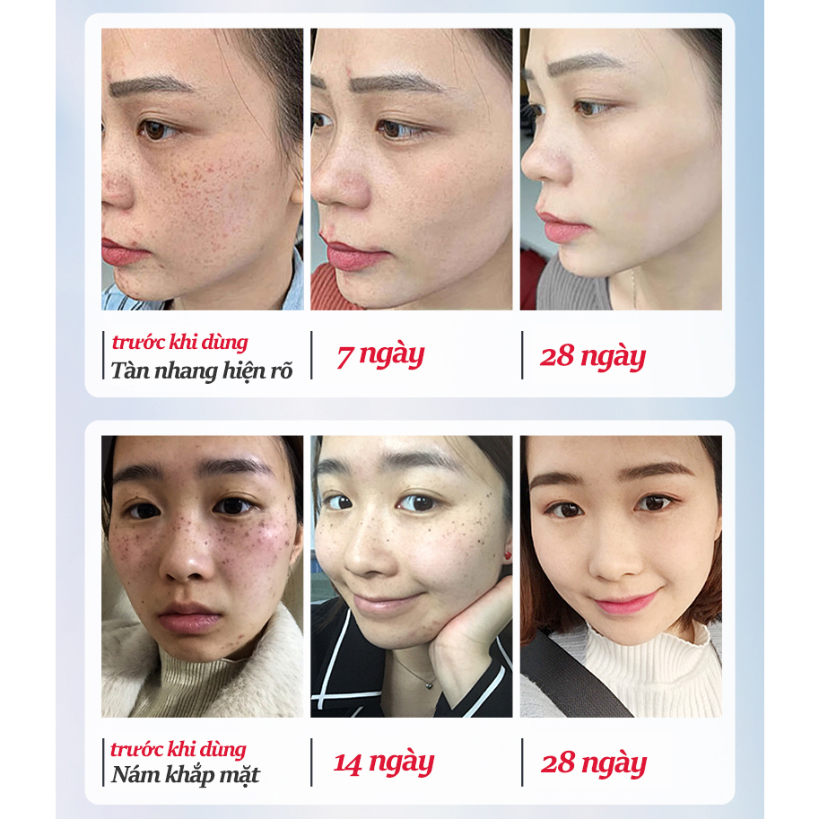 Kem trắng da và xóa tàn nhang Kem nám tàn nhang 20g kem dưỡng trắng da mặt Hiệu quả làm mờ thâm nám tàn nhan se khít lỗ châ