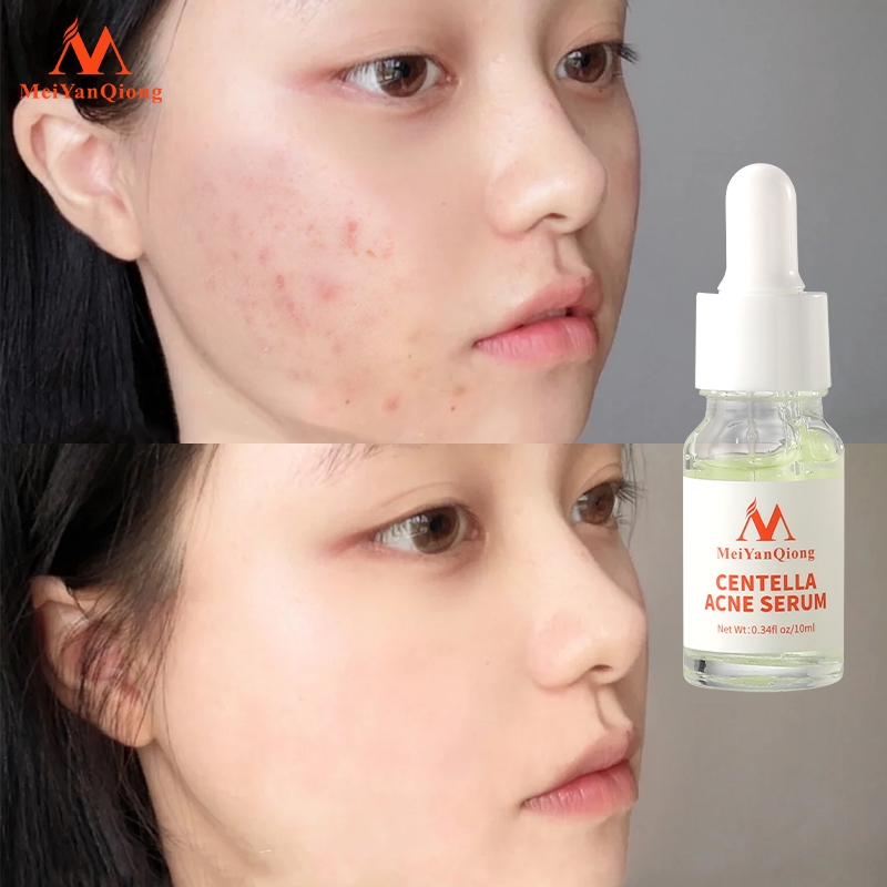 Serum hỗ trợ trị Mụn Trứng Tinh Chất Rau Má MeiYanQiong Kiềm Dầu Và Dưỡng Ẩm 10ml