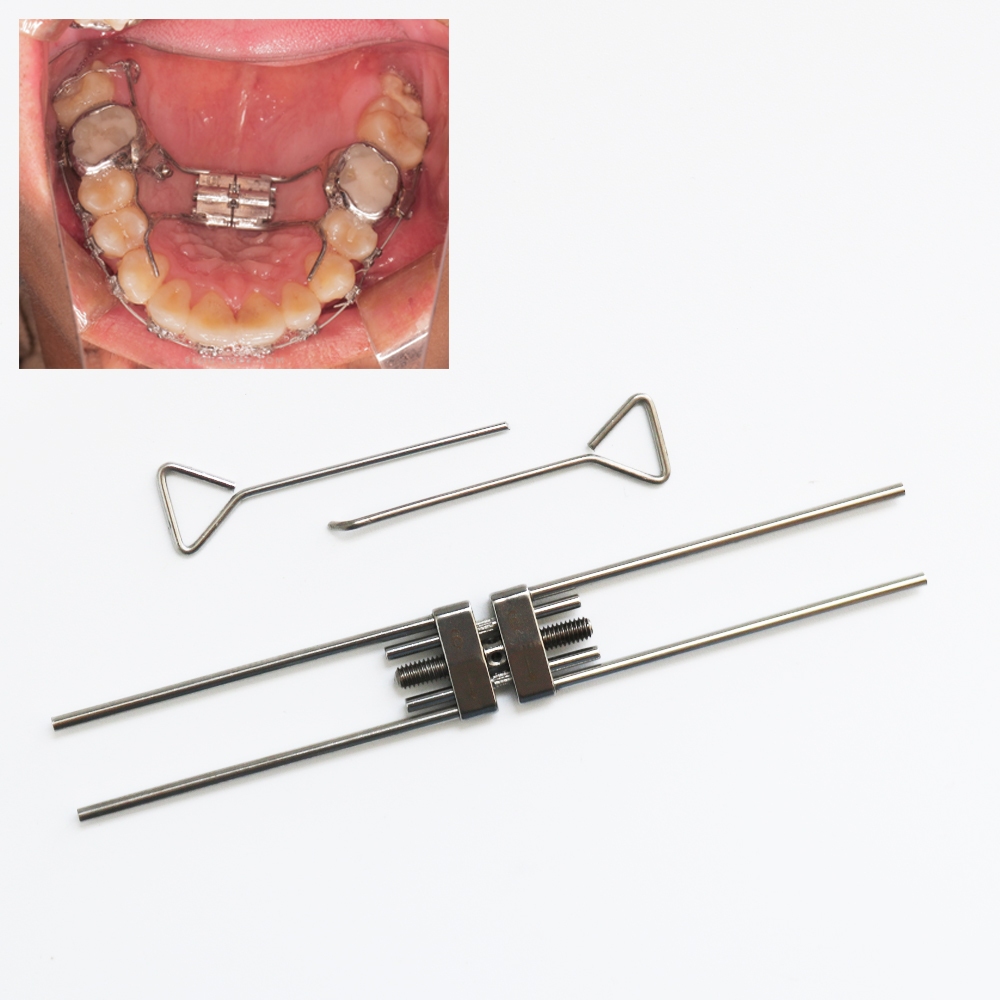 Dây Thép Không Gỉ Chỉnh Hình Răng Kèm Ốc Vít Chuyên Dụng Expansion Screws