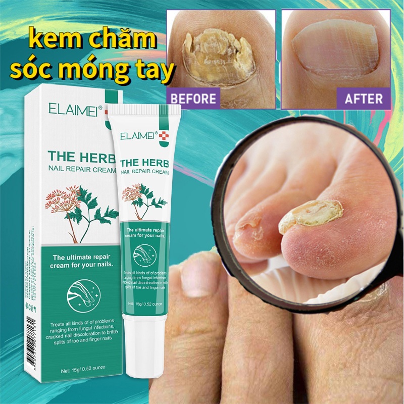 ❤️100% Chính Hãng❤️ kem loại bỏ nấm móng Tinh chất phục hồi móng 15g Giúp loại bỏ nấm khỏi móng chân bị thối Cải thiện vết nứt móng