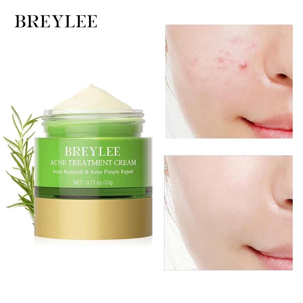 BREYLEE Kem Tinh Chất Hỗ Trợ Giảm Mụn Mặt 20g / 0.71 Floz