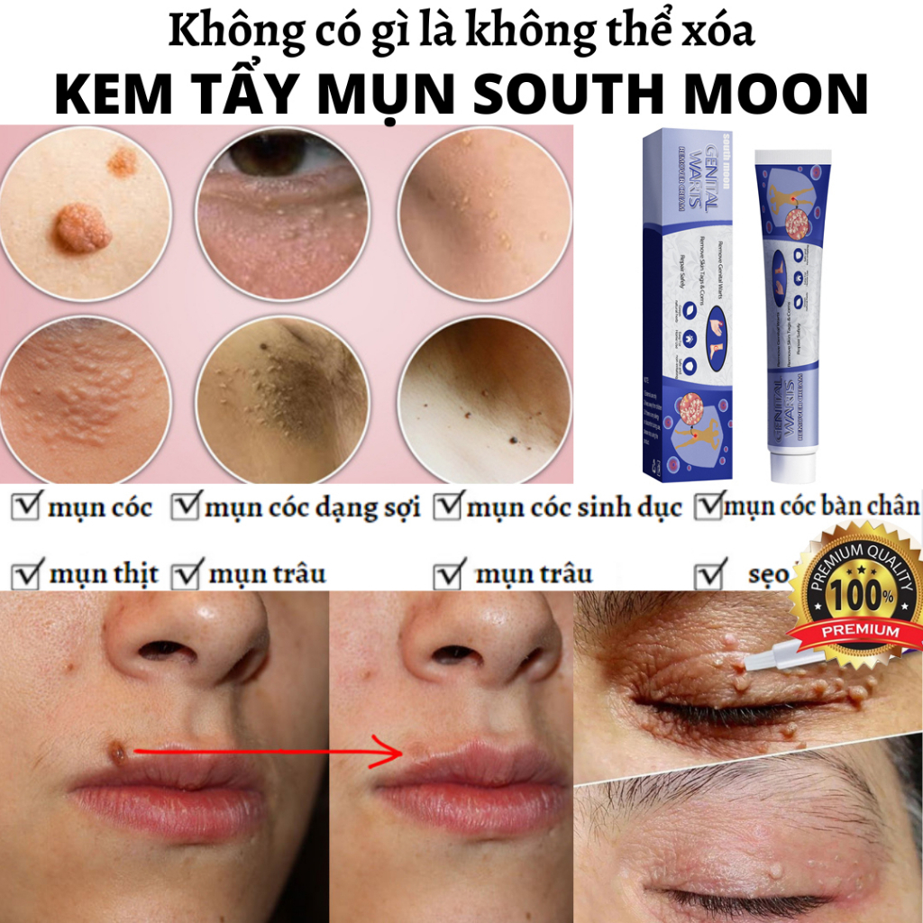【Hiệu quả sau 7 ngày】kem xoá mụn cóc , mụn thịt , loại bỏ mụn cóc thông thường ,mụn đá , mụn cơm ,mụn cóc dạng sợi 20g