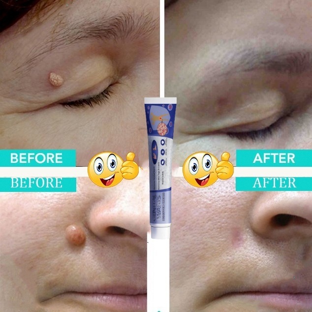 【Hiệu quả sau 7 ngày】kem xoá mụn cóc , mụn thịt , loại bỏ mụn cóc thông thường ,mụn đá , mụn cơm ,mụn cóc dạng sợi 20g