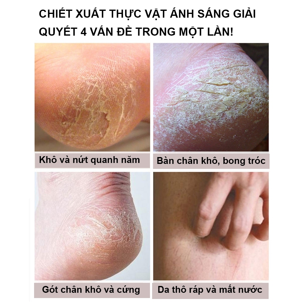 ⭐CHÍNH HÃNG⭐ kem trị nứt gót chân kem nứt gót chân kem bôi nứt gót chân Kem Dưỡng Ẩm Chống Nứt Nẻ Gót Chân 100ml Chống Nẻ Da Tay Chân á sừng Bong da Nứt Gót Chân Dưỡng Ẩm Làm Trắng Da