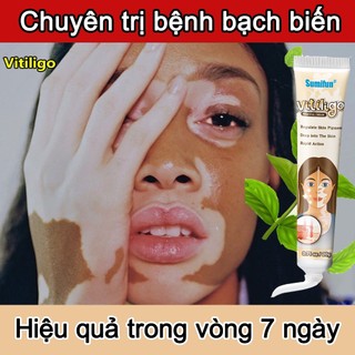 Kem bôi bạch biến Thảo dược bôi bạch biến Bỏ đốm trắng trên da 20g Thúc đẩy tăng trưởng hắc tố chăm sóc da