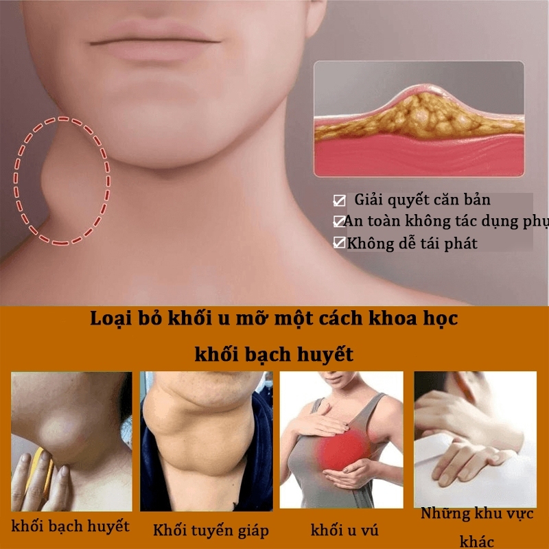 Kem tan u mỡ Kem tan mỡ Kem lipoma 20g Kem tan mỡ chính hãng cho nhiều cục u dưới da đơn lẻ u tuyến