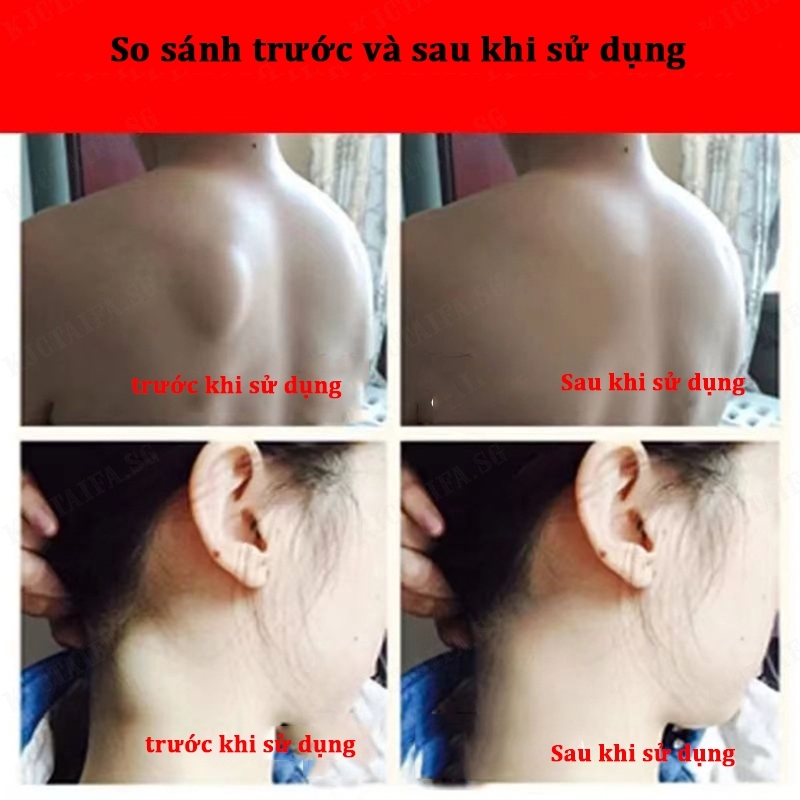 Kem tan u mỡ Kem tan mỡ Kem lipoma 20g Kem tan mỡ chính hãng cho nhiều cục u dưới da đơn lẻ u tuyến