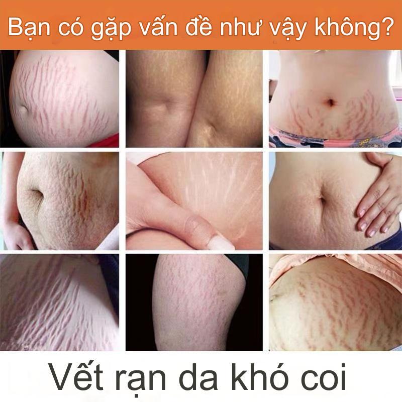 Kem rạn da(Xóa rạn da nhanh chóng trong 7 ngày) 40g Kem xoá rạn da sau sinh, làm mờ vết thâm, sáng đều màu da, cải thiện sẹo lâu năm, kem phục hồi săn chắc