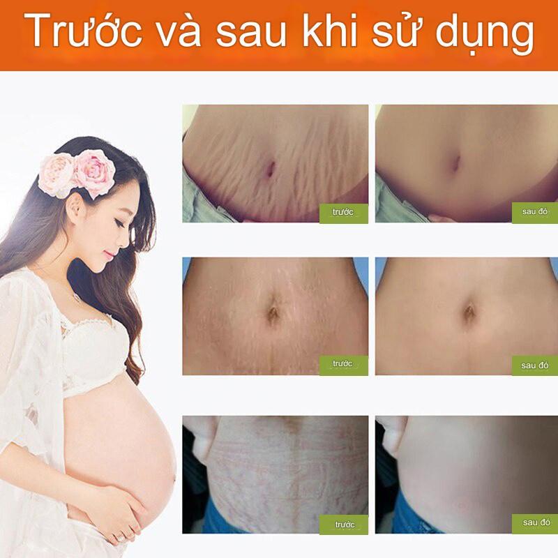Kem rạn da(Xóa rạn da nhanh chóng trong 7 ngày) 40g Kem xoá rạn da sau sinh, làm mờ vết thâm, sáng đều màu da, cải thiện sẹo lâu năm, kem phục hồi săn chắc