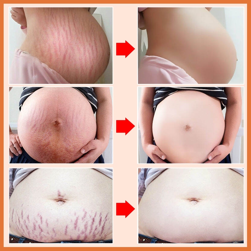 Kem rạn da(Xóa rạn da nhanh chóng trong 7 ngày) 40g Kem xoá rạn da sau sinh, làm mờ vết thâm, sáng đều màu da, cải thiện sẹo lâu năm, kem phục hồi săn chắc
