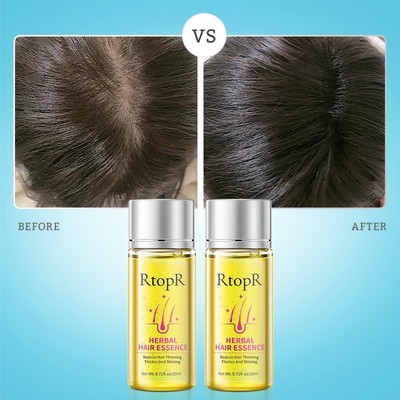 RtopR Tinh dầu dưỡng tóc ngăn rụng tóc  Dầu mọc tóc chống rụng tóc thảo dược, serum kích mọc tóc nhanh, tăng mật độ tóc phục hồi tóc yếu, phù hợp rụng tóc sau sinh