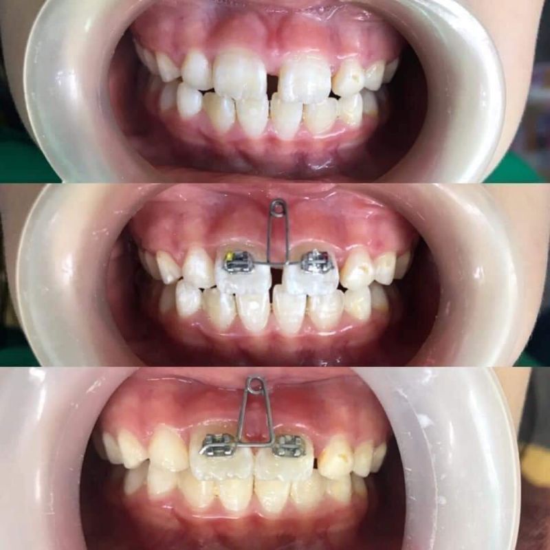 loop đóng khoảng răng cửa