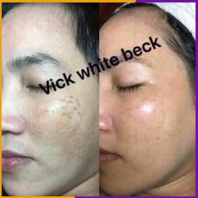 KEM TRÀ XANH VICK WHITE BECK TRẮNG DA- MỤN- THÂM NÁM 15g