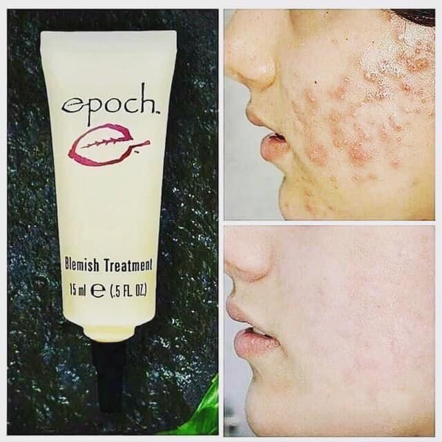 Kem chấm mụn Epoch Blemish Treatment Nuskin