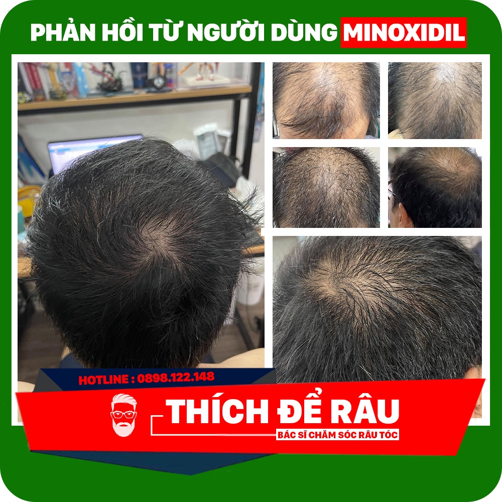 Minoxidil 5% lỏng combo bột LCLT giúp mọc râu nhanh