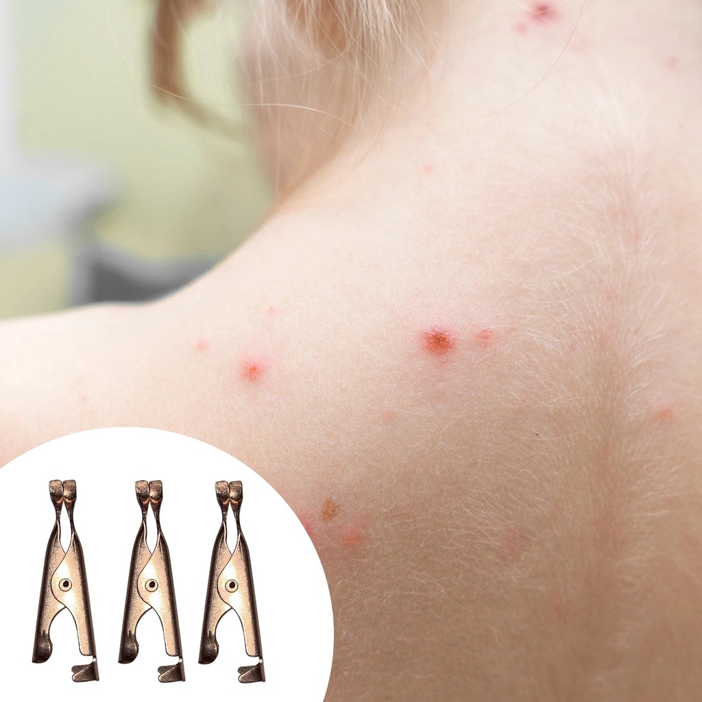 Dụng Cụ Hỗ Trợ Giảm Mụn Đầu Đen / Hình Xăm Dạng Kẹp Tiện Dụng