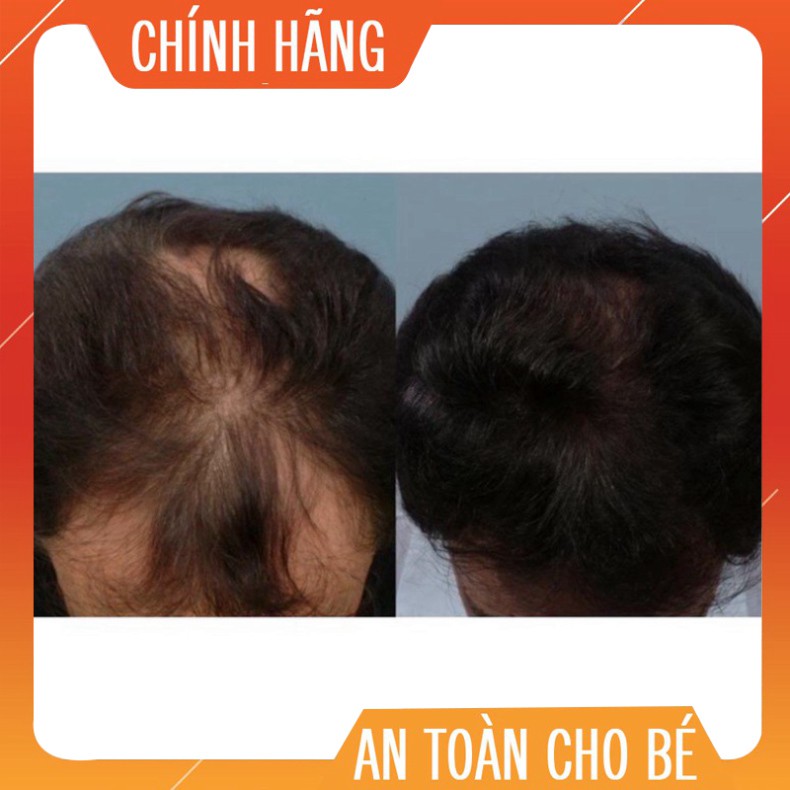 GIÁ CỰC ĐÃ Viên uống hỗ trợ mọc tóc Biotin 10,000mcg - Dùng kèm Minoxidil GIÁ CỰC ĐÃ