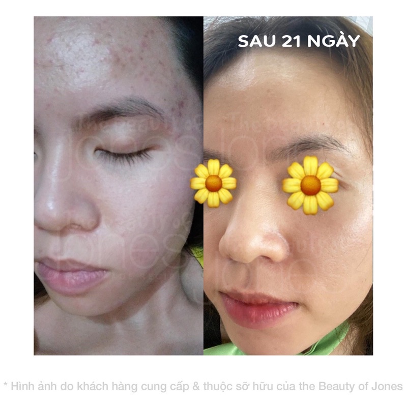 Kem Mụn Dành Cho Da Nhạy Cảm Từ Tràm Trà The Beauty Of Jones
