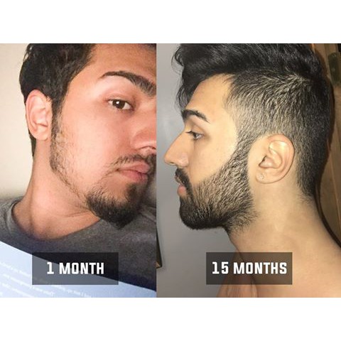 Minoxidil 5% Kirkland chính hãng - Thuốc Mọc Râu Tóc - Trị Hói - Dưỡng rậm Chân Mày | BigBuy360 - bigbuy360.vn