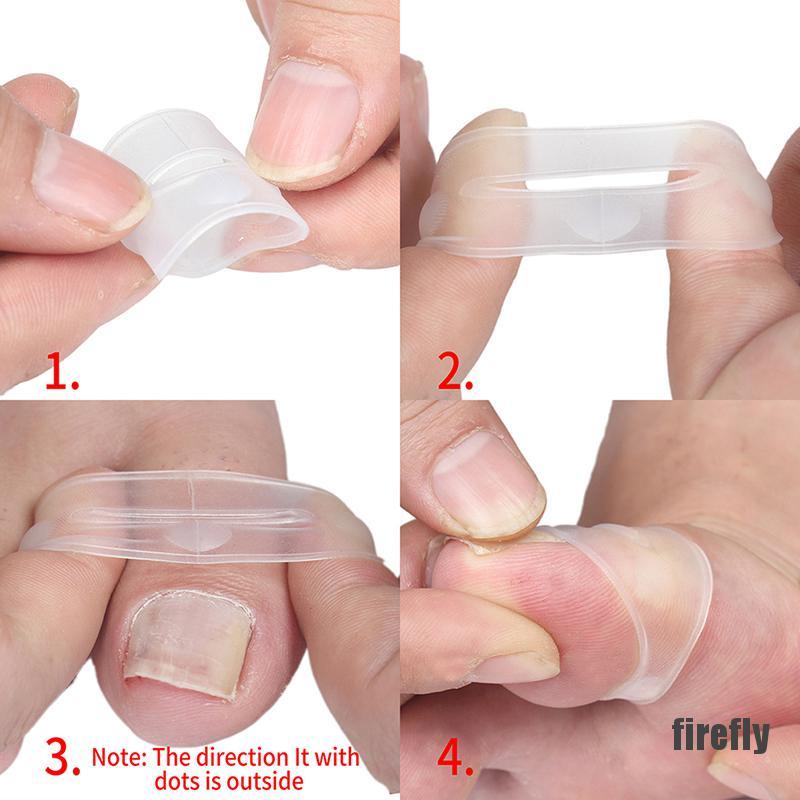 Dụng Cụ Silicone Chỉnh Hình Móng Chân Mọc Ngược