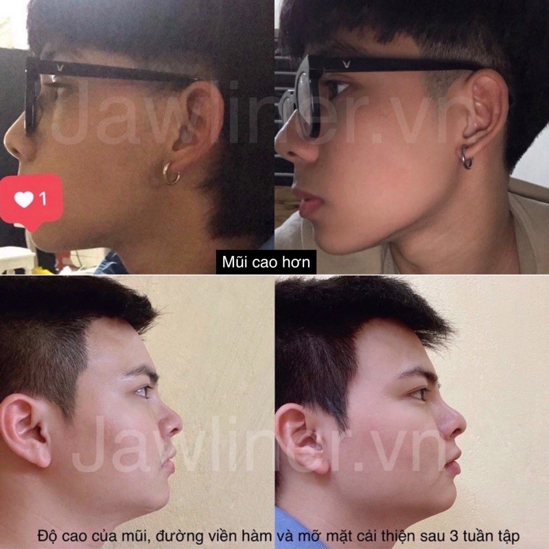 [CHÍNH HÃNG JAWLINER ĐỨC] Bộ gồm 2 viên Jawliner tập cơ hàm giảm mỡ nọng phát triển cơ, mũi và jawline - Jawliner.vn