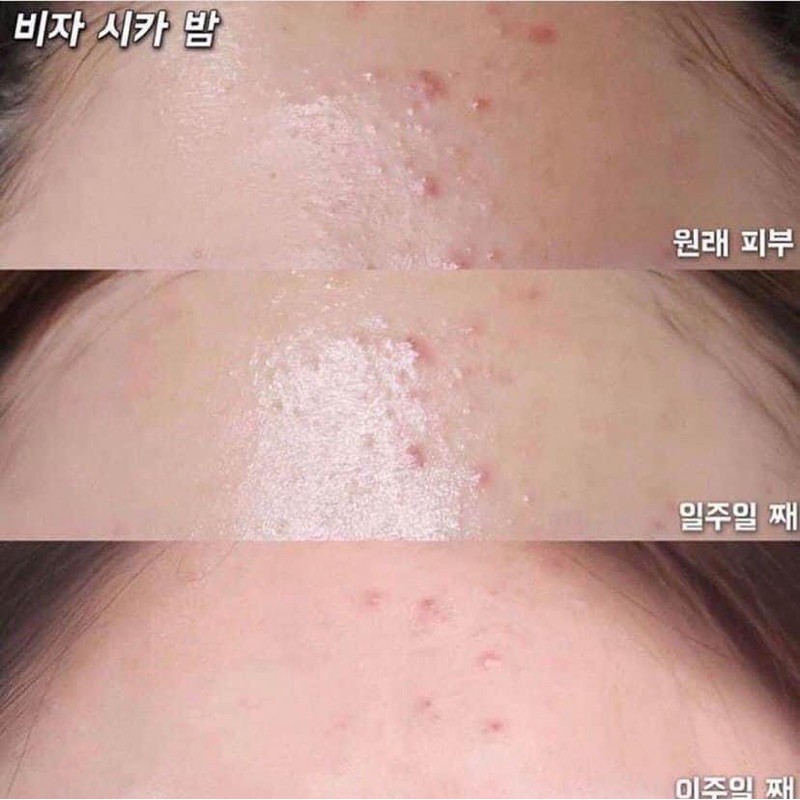 Gel chấm mụn Tea Tree Oil